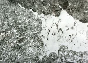 M, 1y. | epidermolysis bullosa … junctional type M, 1y. | epidermolysis bullosa … junctional type